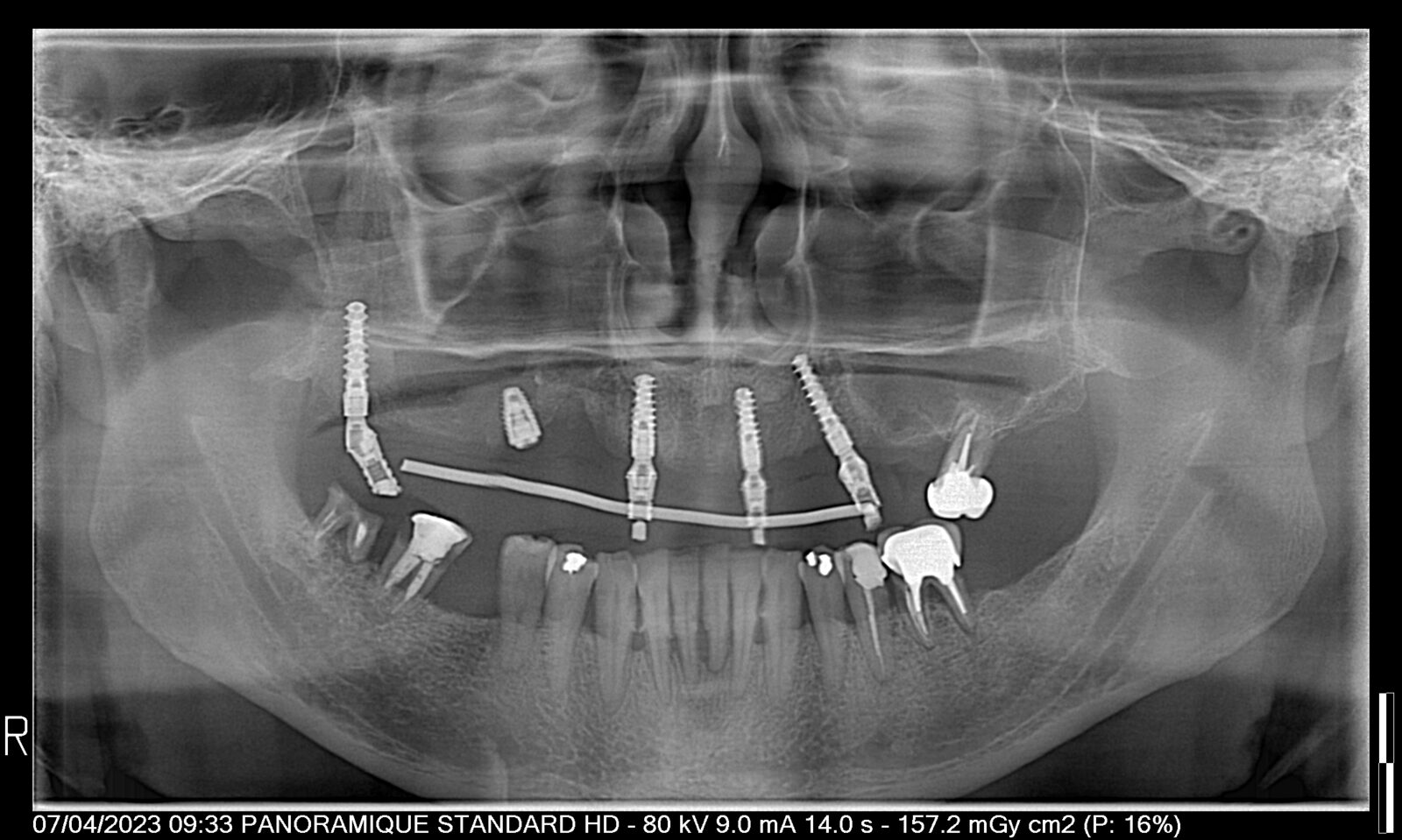 Panoramic — full-arch implant rehabilitation