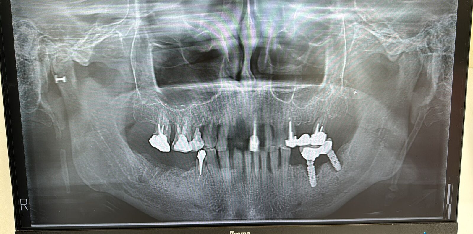 Panoramic — trans-sinus and pterygoid implants