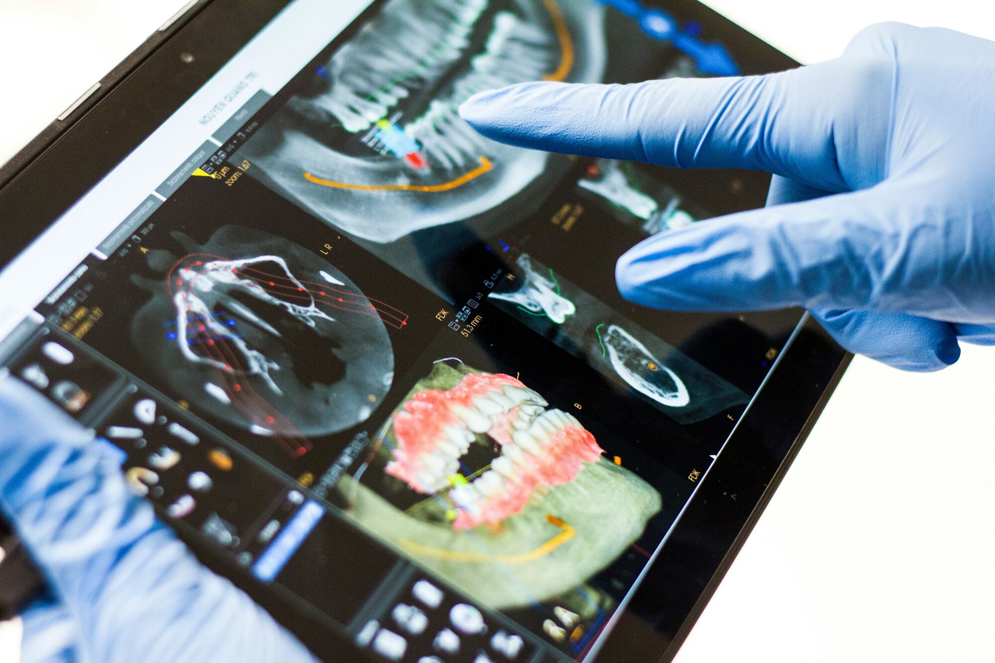 Implant planning with CBCT imaging